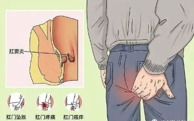 肛窦炎要当心,它可让人不省心!(图2) 肛窦炎要当心,它可让人不省心!(图2)