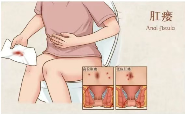 肛瘘症状有哪些？怎么知道自己是不是患上肛瘘了呢？(图1)
